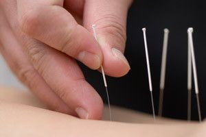 Acupuncture Package - Karaoke